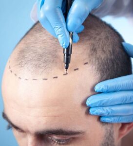 Hair Transplantation